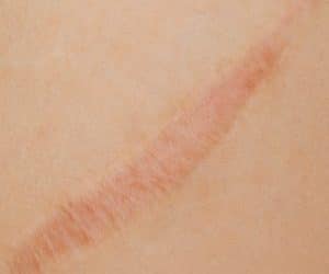 The Role of Inflammation in Scar Treatment