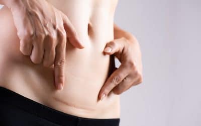 Postpartum Scars: A Journey of Healing