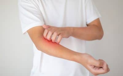 Soothing Creams in the Management of Atopic Dermatitis